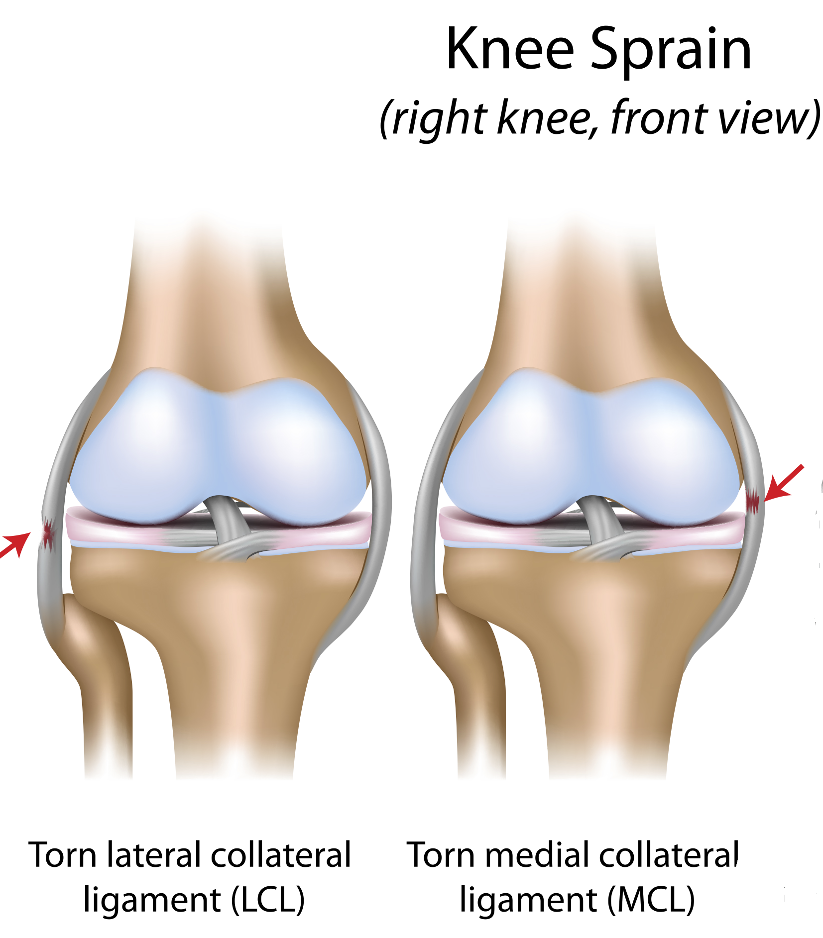 What is the quickest possible recovery time after knee surgery for a torn meniscus?